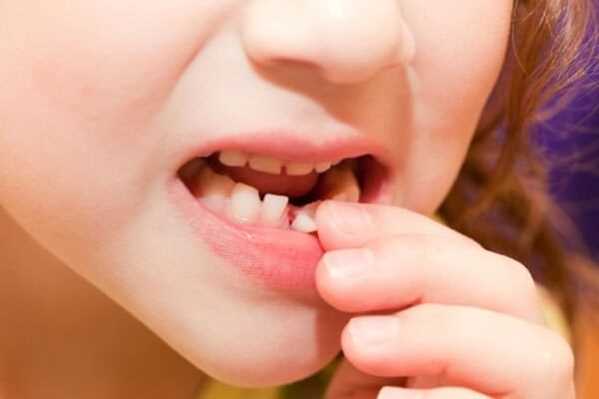 تعبیر خواب افتادن دندان نیش – افتادن دندان شیری و دندان آسیاب در خواب چه تعبیری دارد